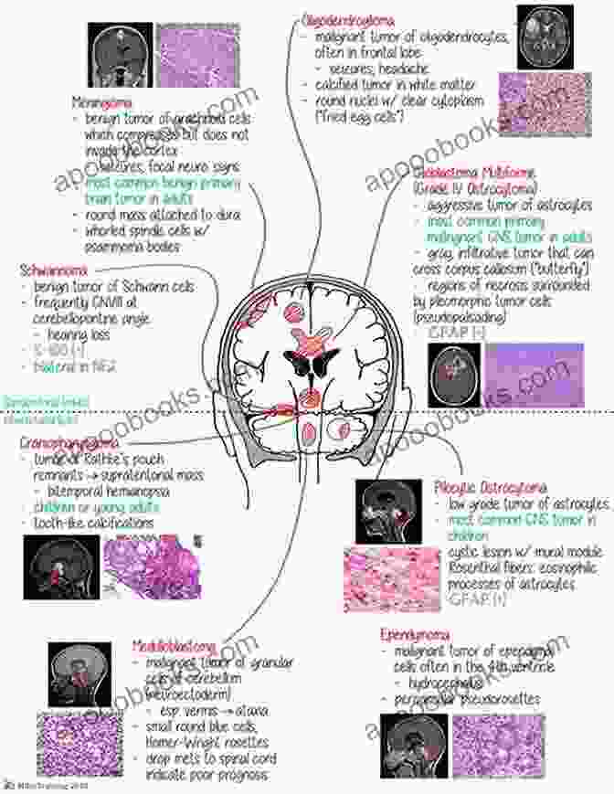 Complex Vascular Lesions And Tumors Of The Nervous System Neurosurgery Of Complex Vascular Lesions And Tumors