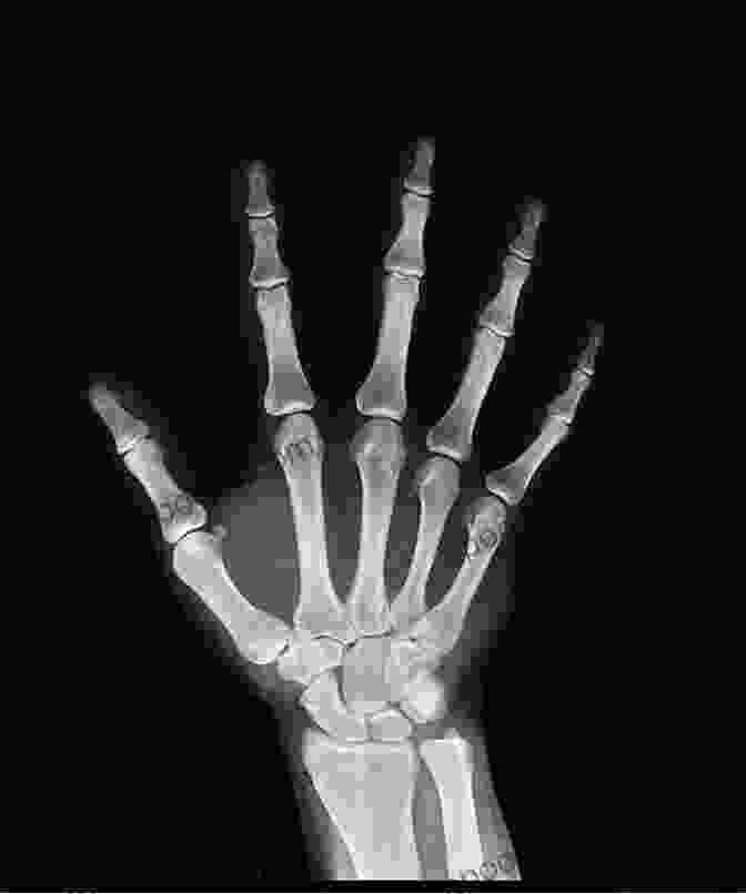X Ray Image Of The Hand Hand Surgery Study Guide Steven F Viegas